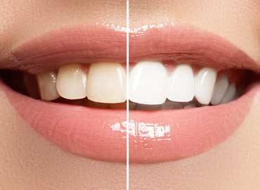 Clareamento Dental — Uniorto Ortodontia