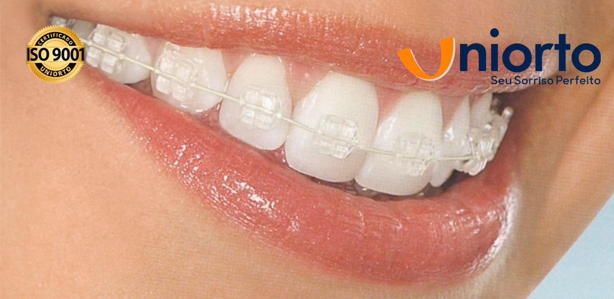 Aparelho de Porcelana — Uniorto Ortodontia