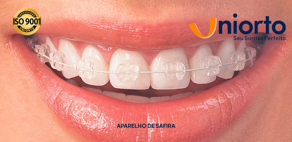 Aparelho de Safira — Uniorto Ortodontia
