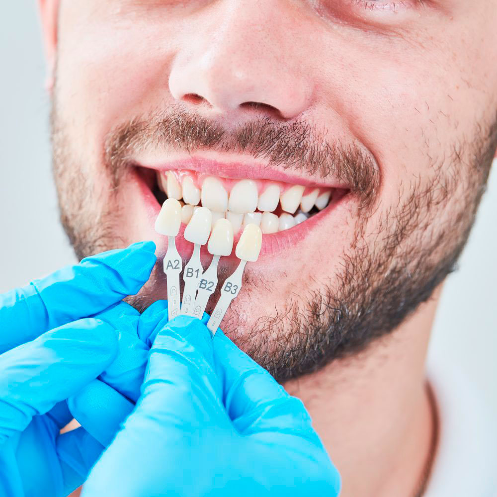 Tratamento com facetas e lentes dentais na Uniorto
